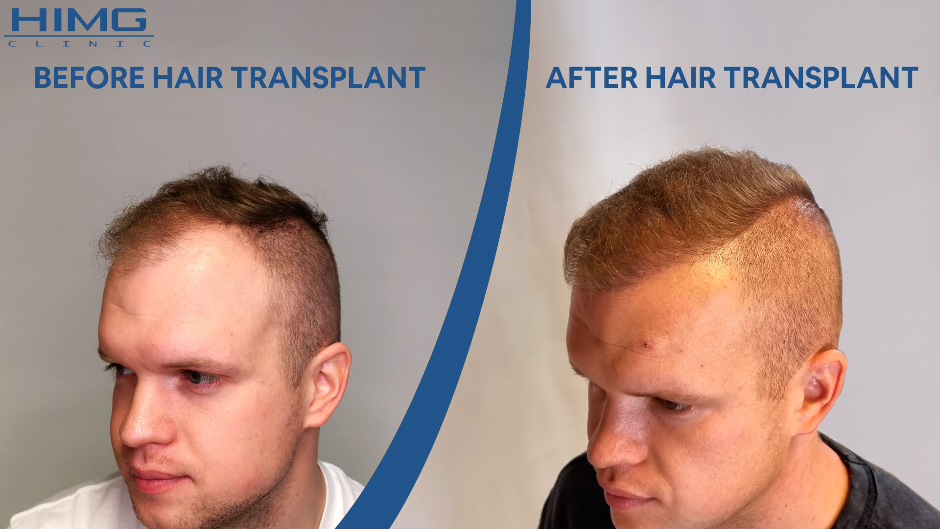 Hair transplant before-after: Patrik