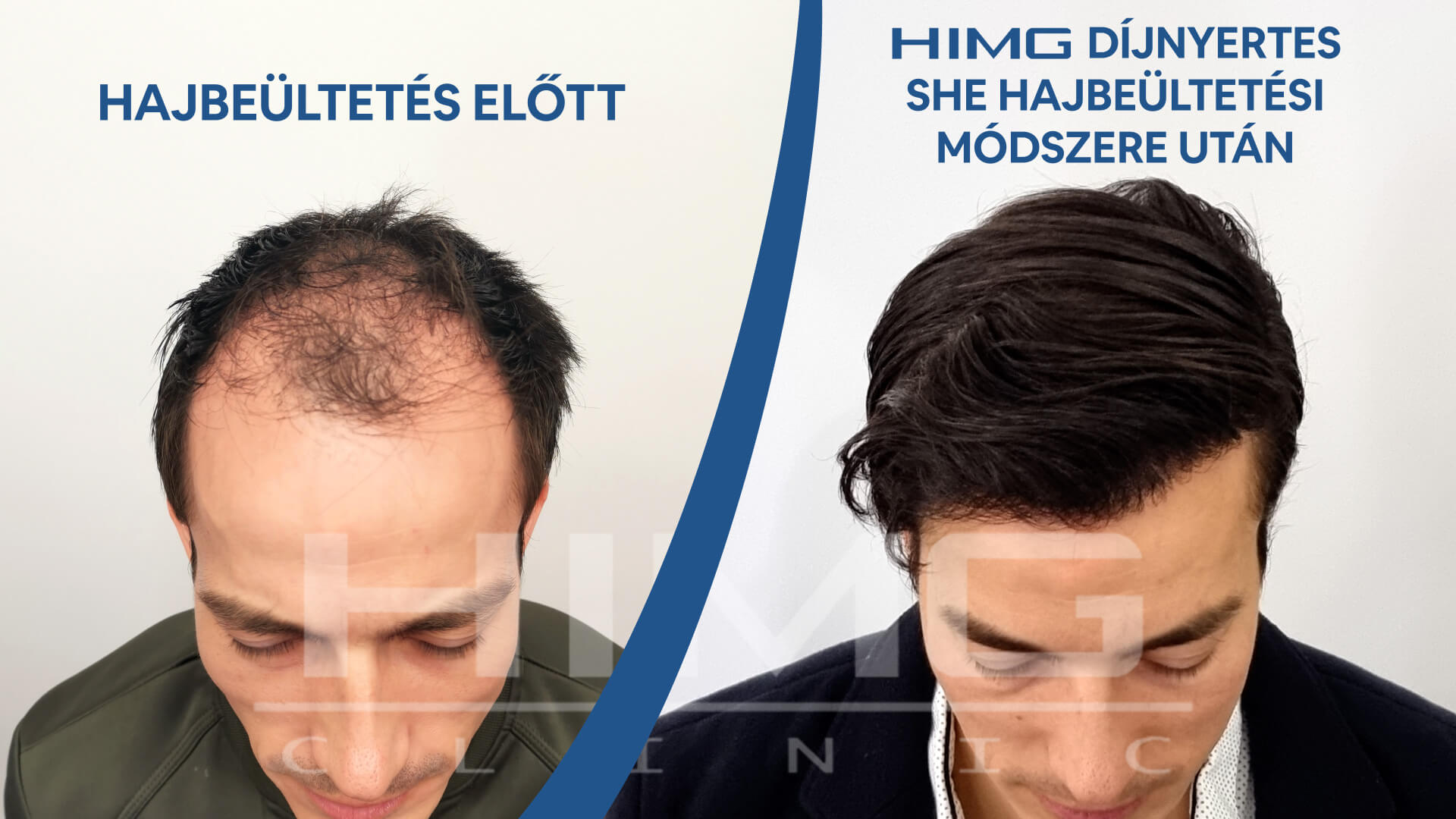 Hajbeültetés előtte-utána: Gergő - HIMG hajbeültetési klinika