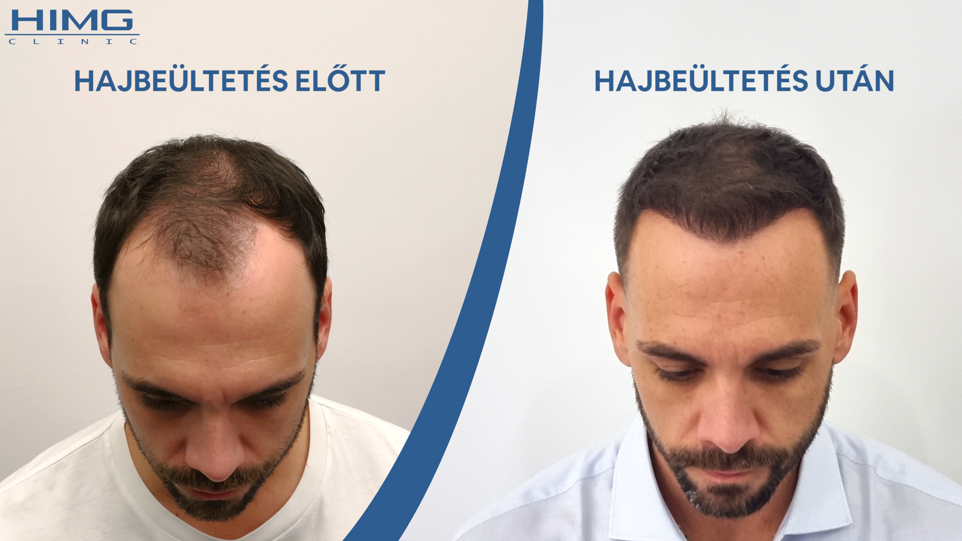 Balázs hajbeültetés előtt és után Balázs hajbeültetés előtt és után