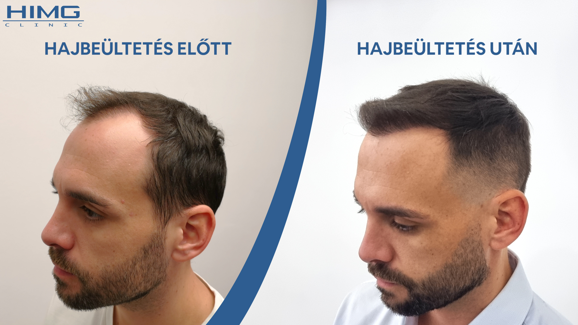 Balázs hajbeültetés előtt és után Balázs hajbeültetés előtt és után