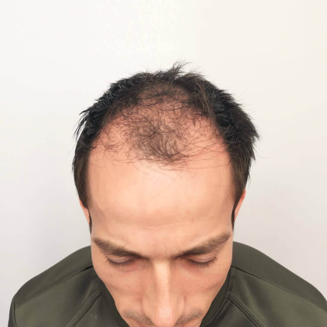 Hajbeültetés előtte-utána: Gergő - HIMG hajbeültetési klinika