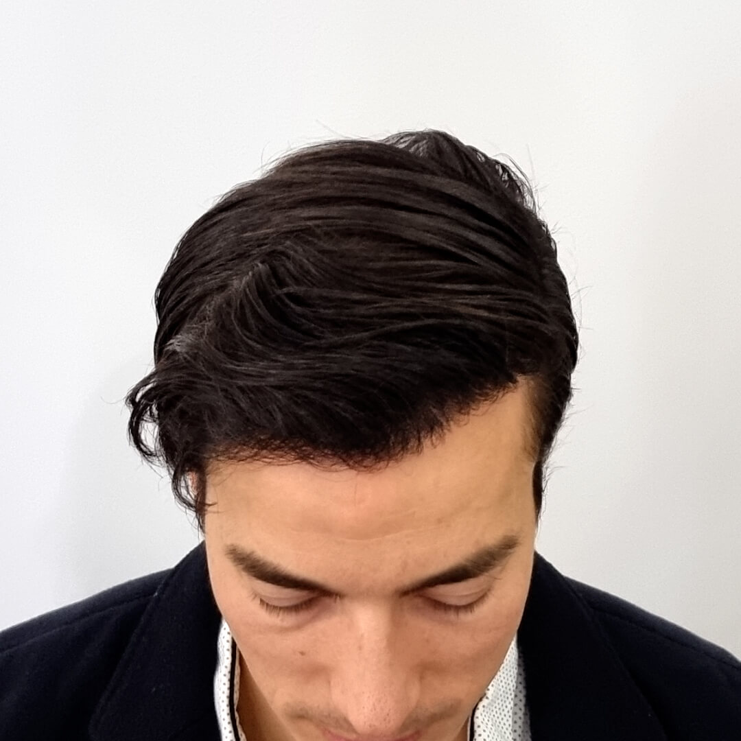 Gergő's Before-and-After Results Using the SHE Method (Over 9,800 Transplanted Hair Follicles)