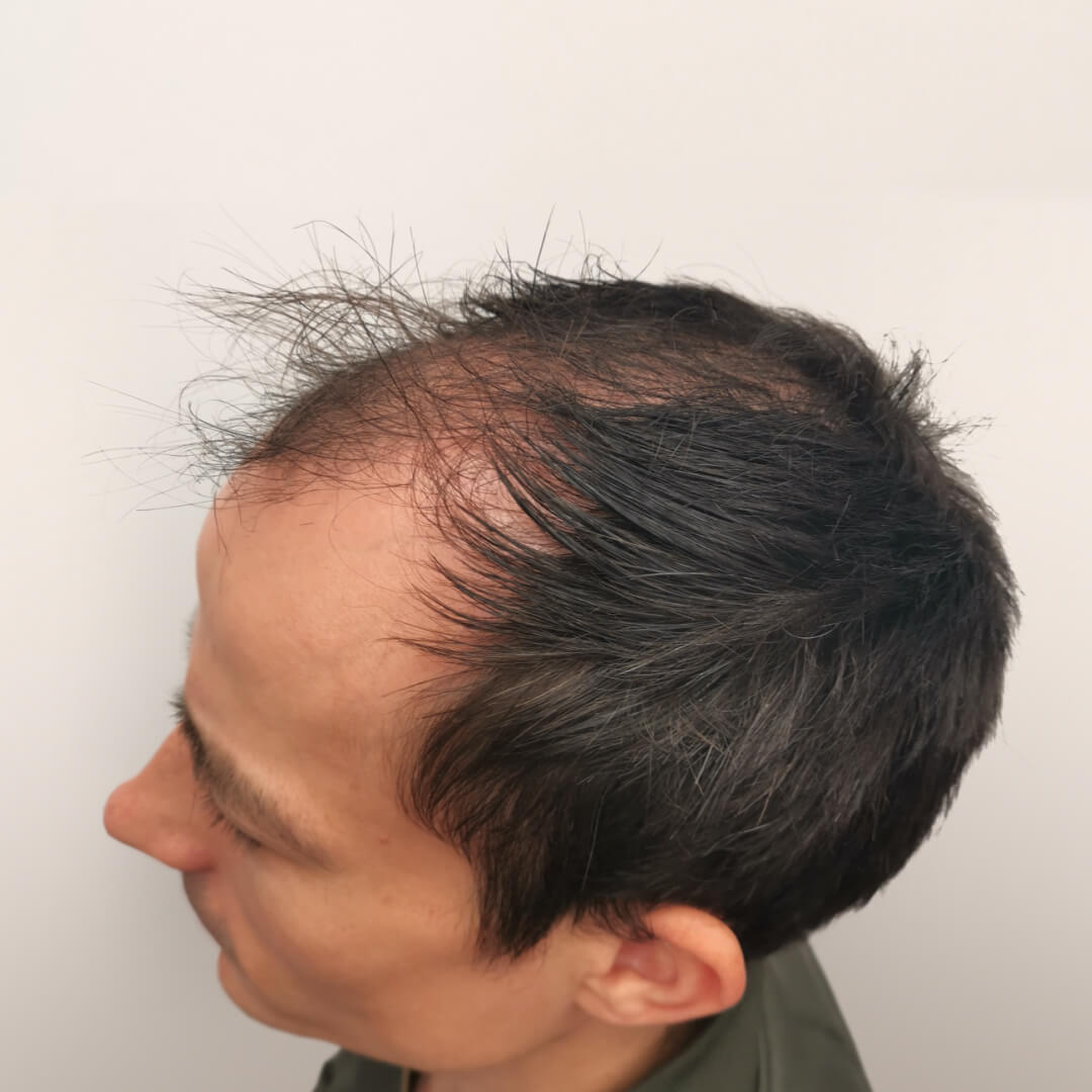 Gergő's Before-and-After Results Using the SHE Method (Over 9,800 Transplanted Hair Follicles)