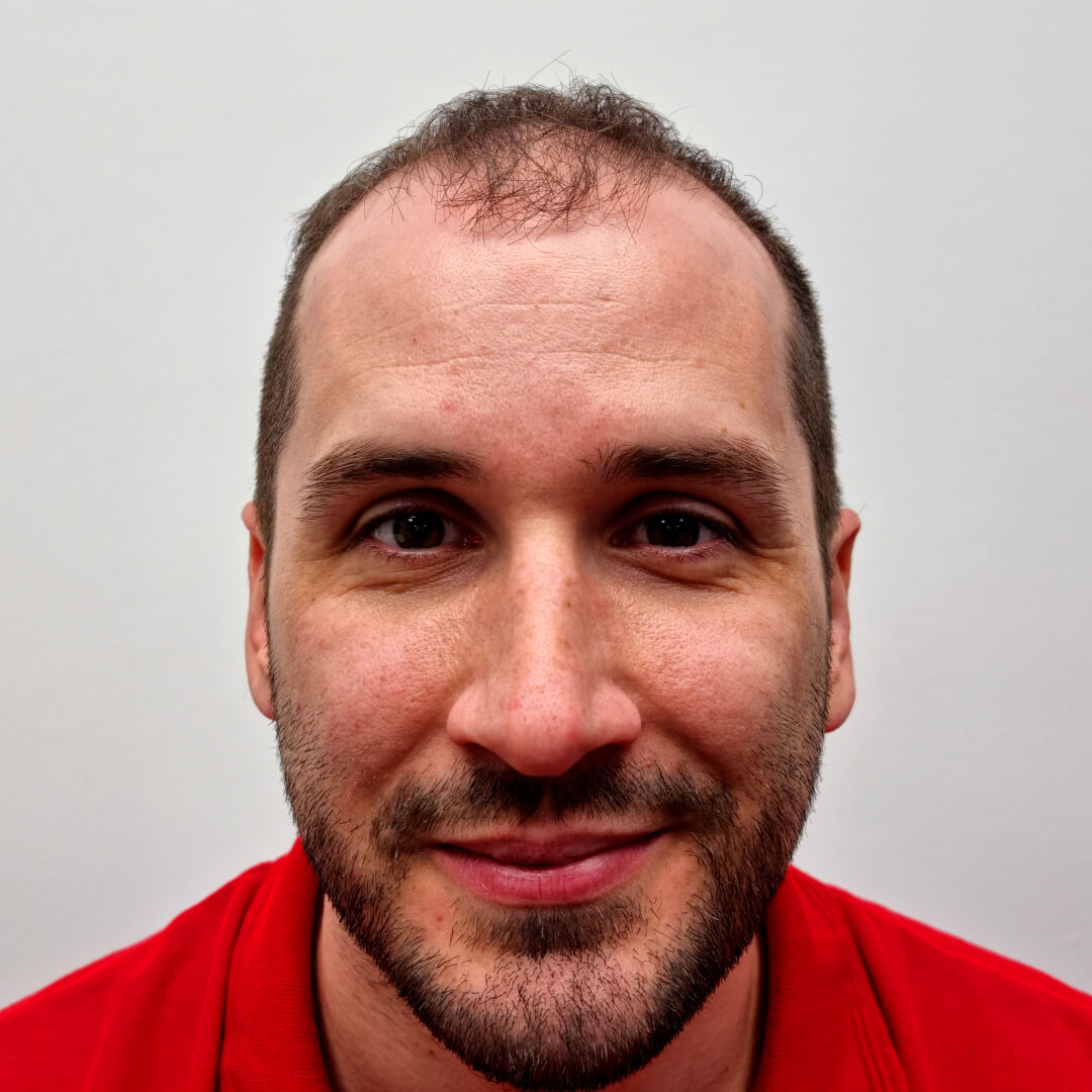 Norbert Kiss - before hair transplant - HIMG Hair Transplant Clinic