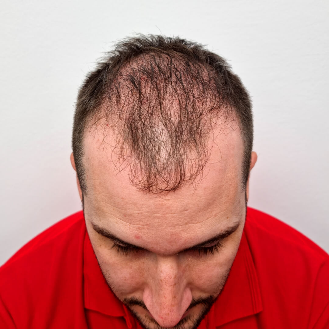 Norbert Kiss - before hair transplant - HIMG Hair Transplant Clinic