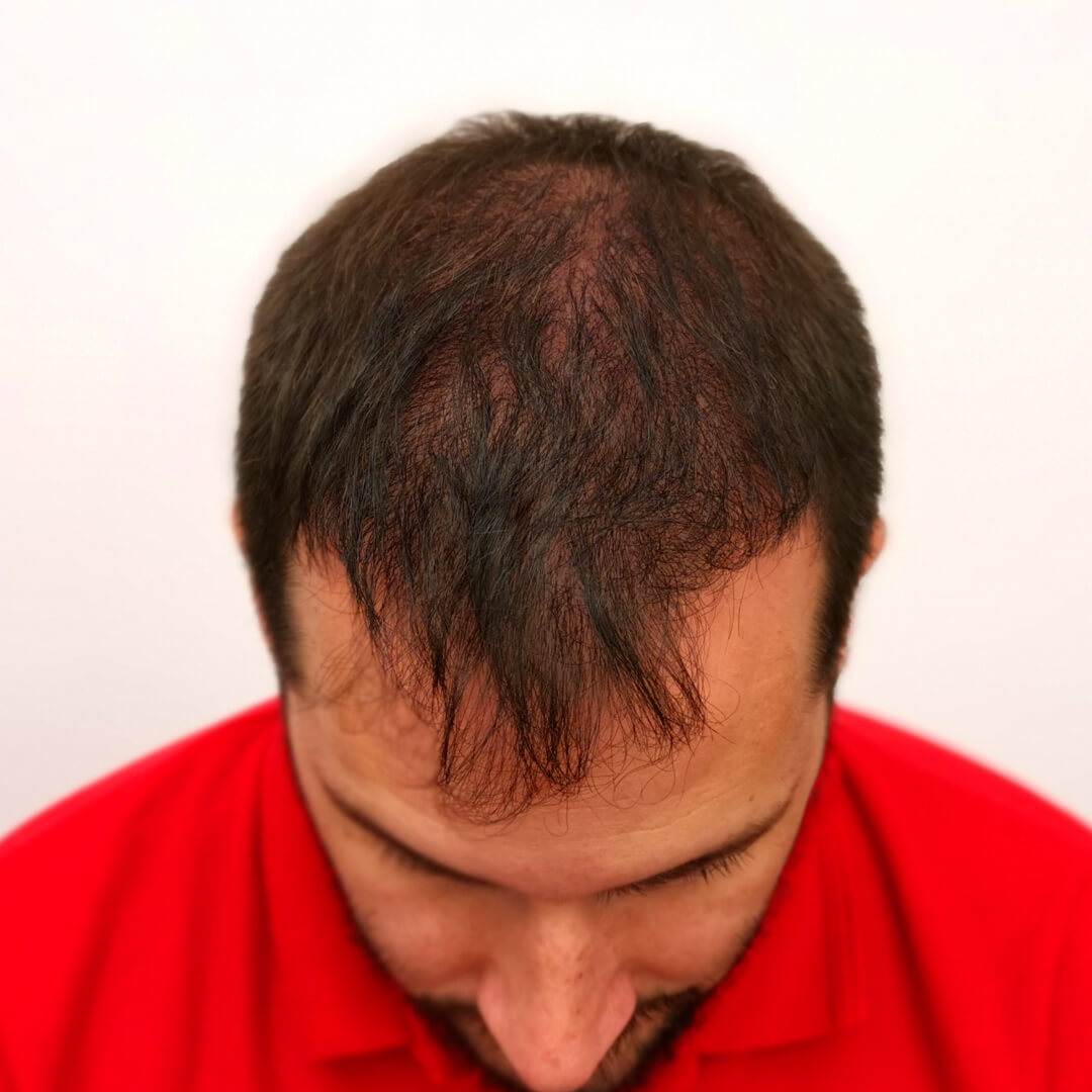 Norbert Kiss - before hair transplant - HIMG Hair Transplant Clinic