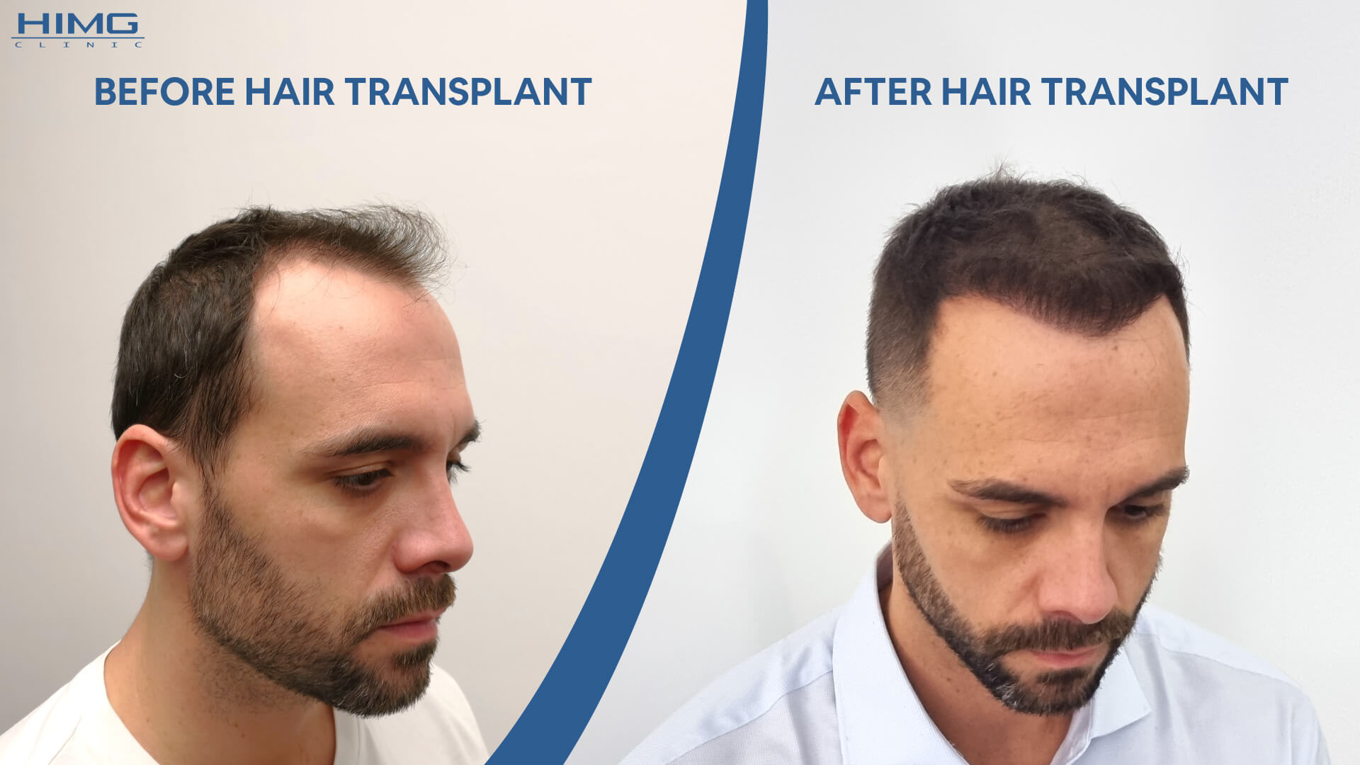 Hair Transplant before-after: Balázs - HIMG Hair Transplant Clinic