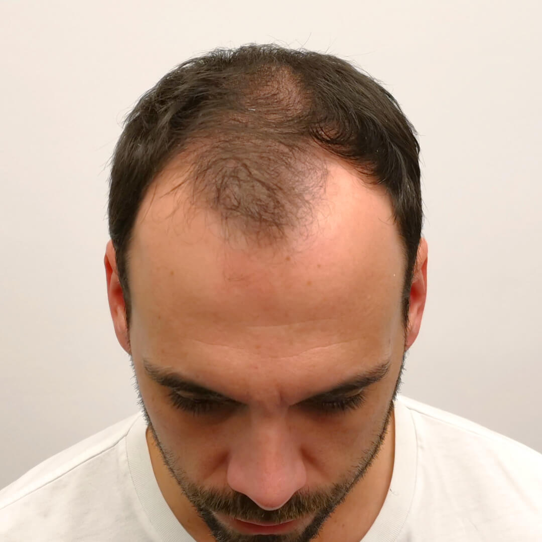 Hajbeültetés előtte-utána: Balázs - HIMG hajbeültetési klinika
