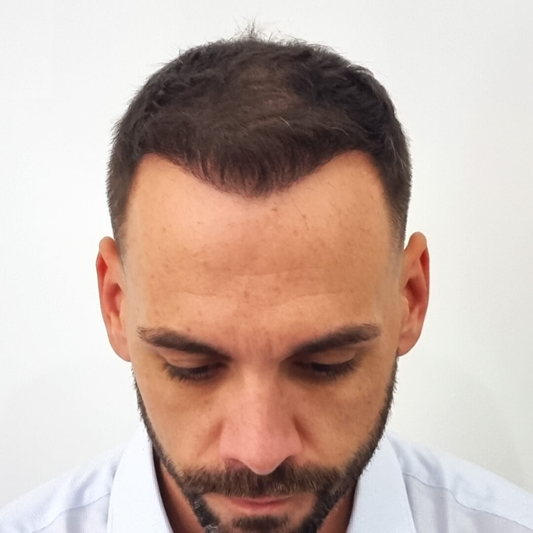 Hajbeültetés előtte-utána: Balázs - HIMG hajbeültetési klinika