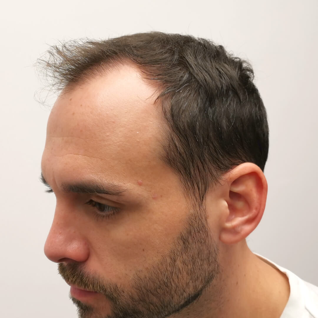 Hajbeültetés előtte-utána: Balázs - HIMG hajbeültetési klinika