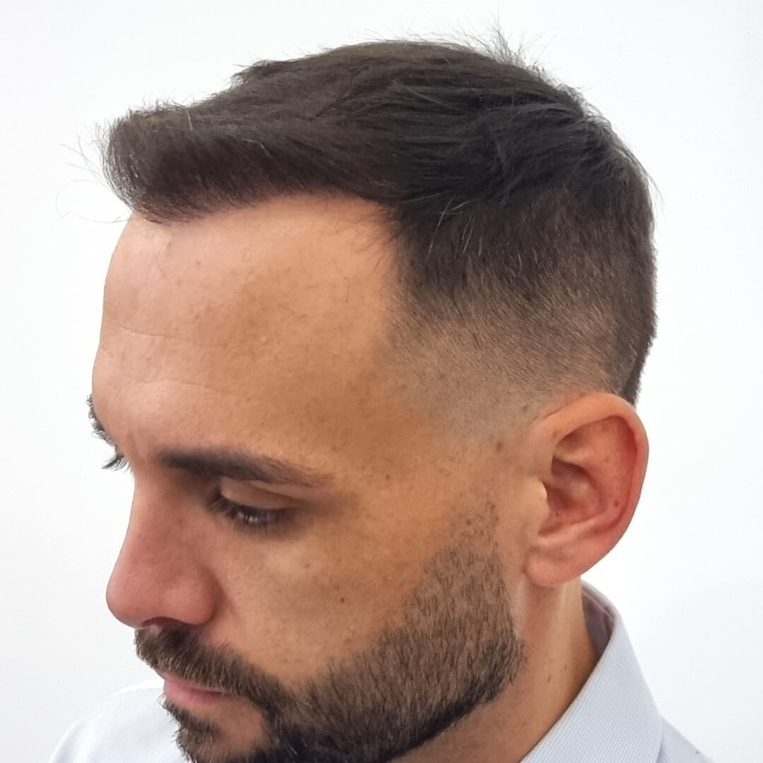 Hajbeültetés előtte-utána: Balázs - HIMG hajbeültetési klinika