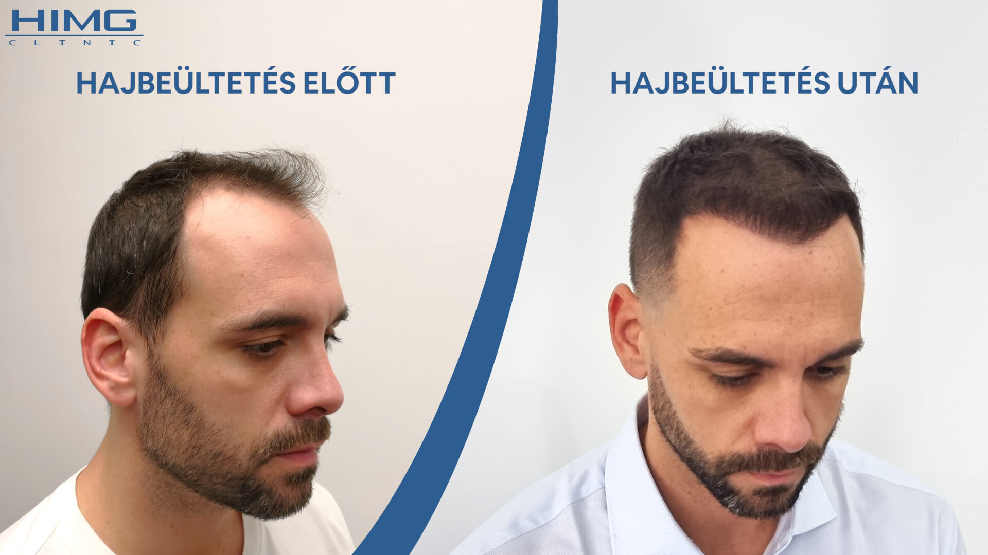 Hajbeültetés előtte-utána: Balázs - HIMG hajbeültetési klinika
