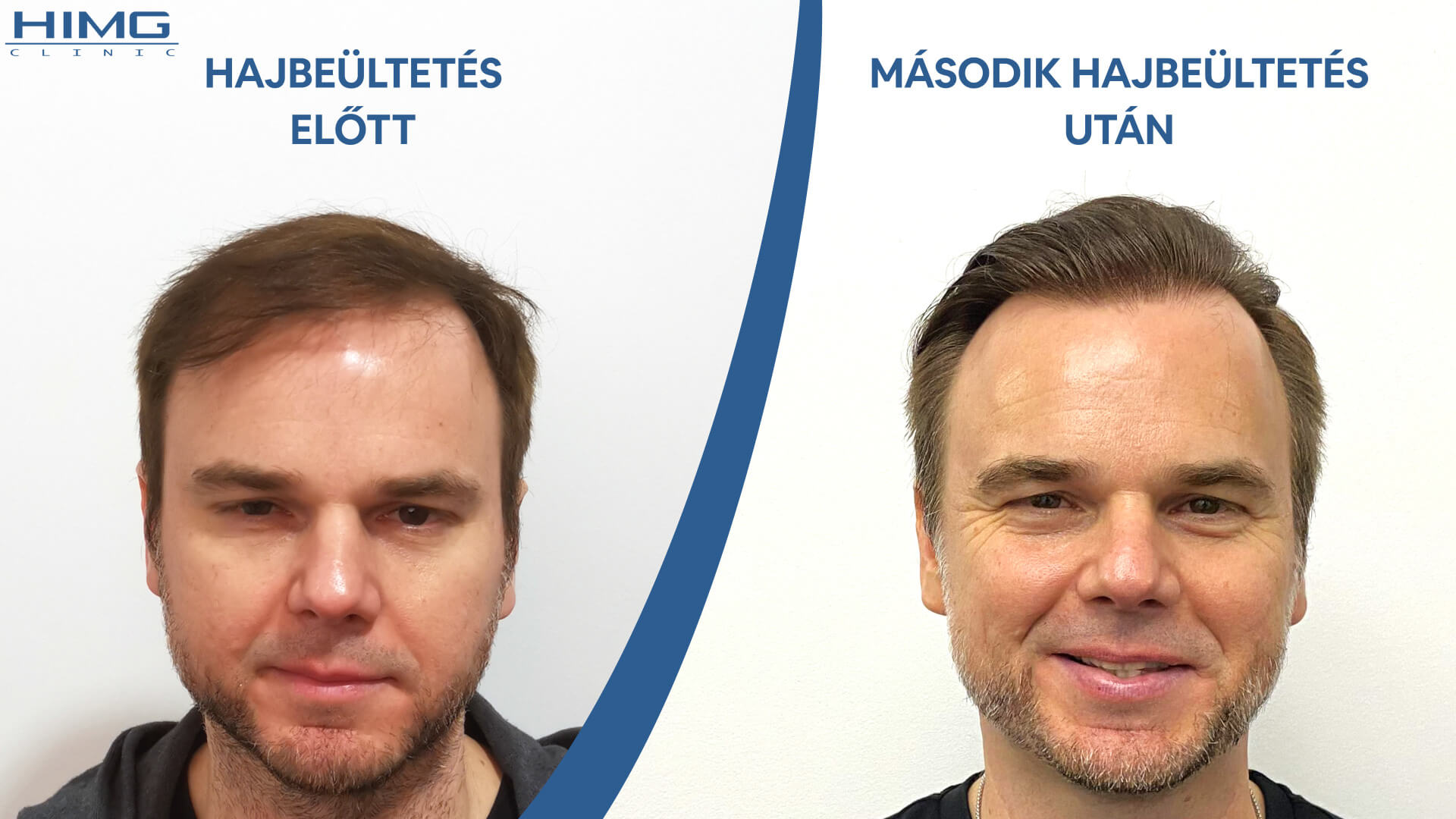 Hajbeültetés előtte-utána: Juhász Gergely (Rádió 1  műsorvezető, író) - HIMG hajbeültetési klinika