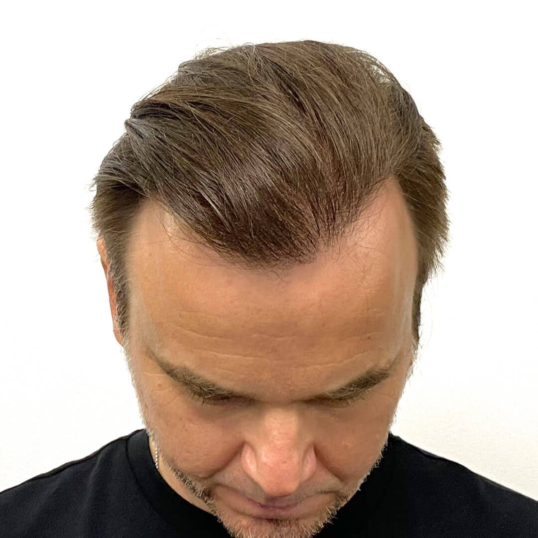 Hajbeültetés előtte-utána: Juhász Gergely (Rádió 1 műsorvezető, író) - HIMG hajbeültetési klinika