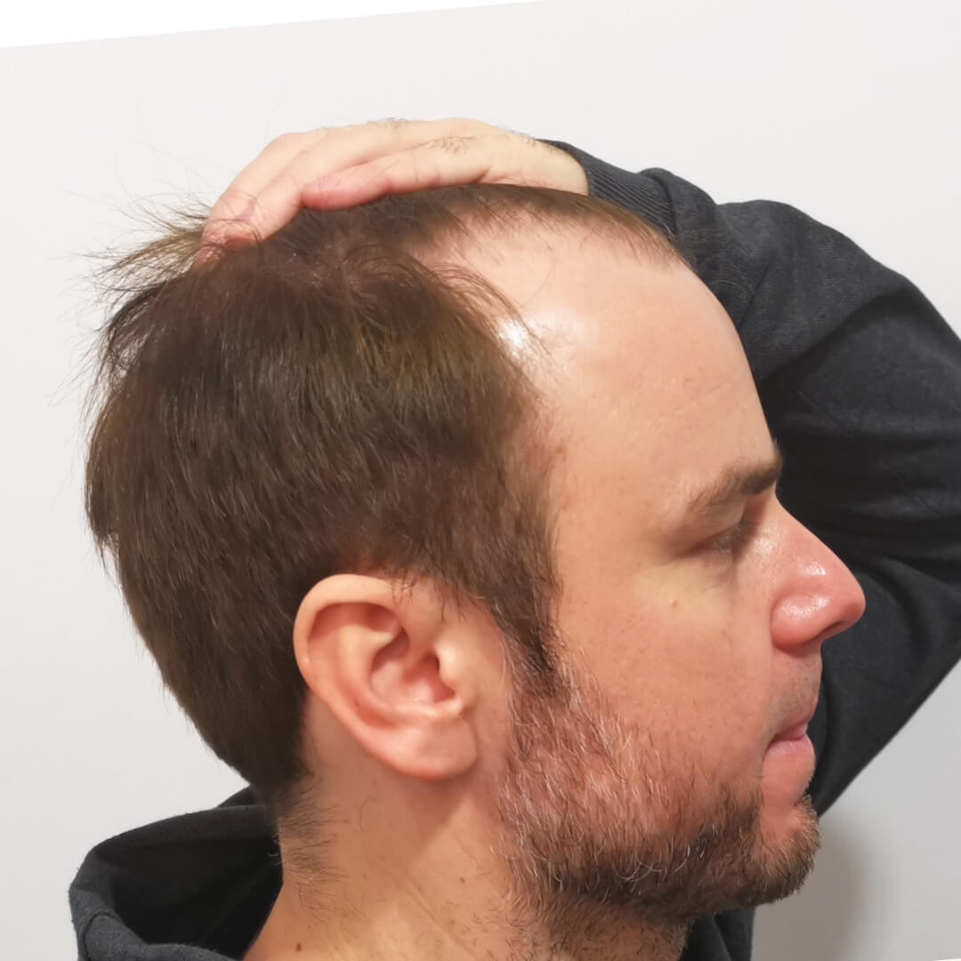 Hajbeültetés előtte-utána: Juhász Gergely (Rádió 1 műsorvezető, író) - HIMG hajbeültetési klinika