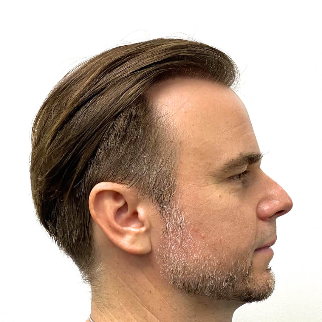 Hajbeültetés előtte-utána: Juhász Gergely (Rádió 1 műsorvezető, író) - HIMG hajbeültetési klinika