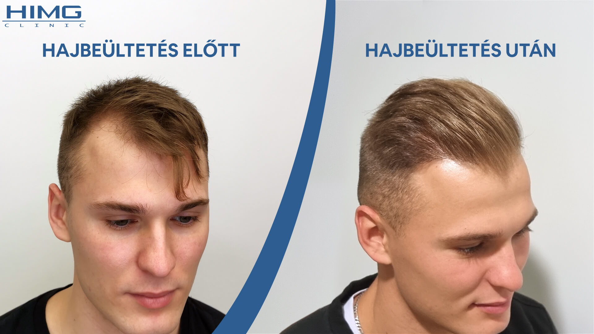 Hajbeültetés előtte-utána: Norbert - HIMG Hajbeültetési Klinika