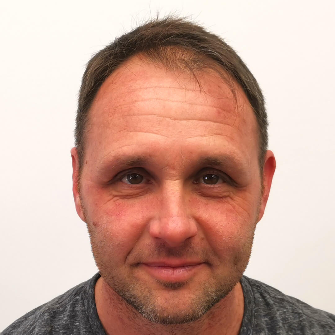 HIMG Hair Transplant Clinic - Example photo 1