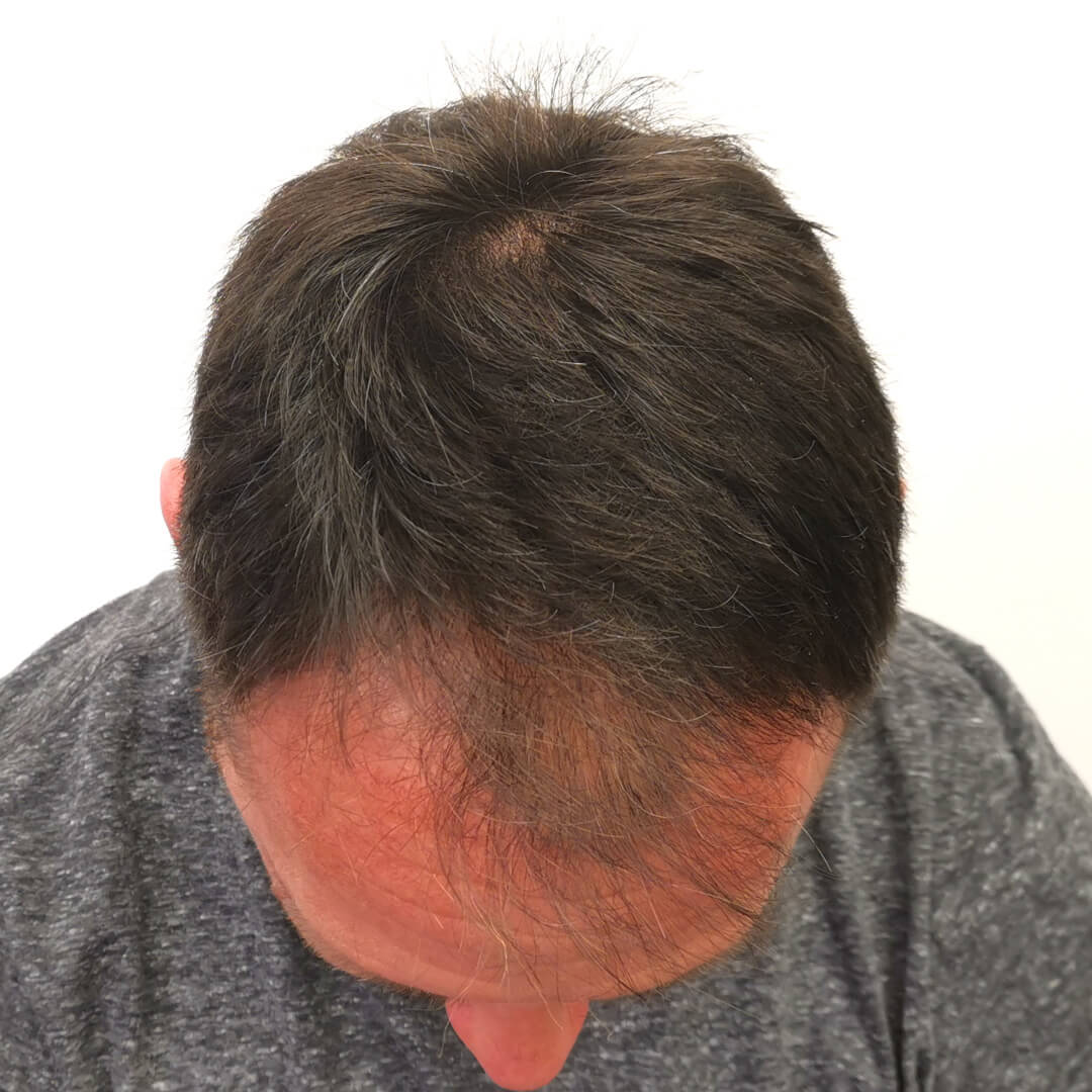 HIMG Hair Transplant Clinic - Example photo 2