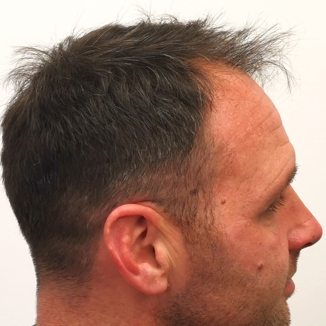 HIMG Hair Transplant Clinic - Example photo 3