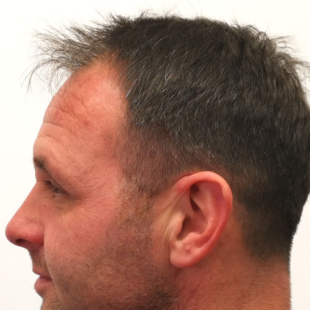 HIMG Hair Transplant Clinic - Example photo 4