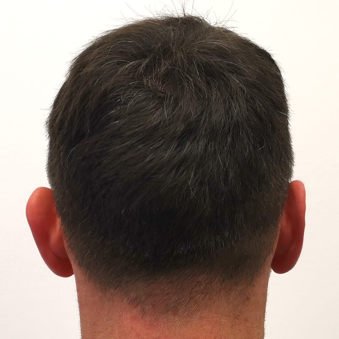 HIMG Hair Transplant Clinic - Example photo 5