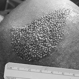 S.H.E. hair implantation method - after direct hair implantation