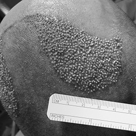 S.H.E. hair implantation method - after direct hair implantation