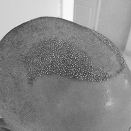 S.H.E. hair implantation method - after direct hair implantation