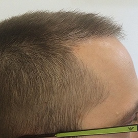 S.H.E. hair implantation method - after direct hair implantation