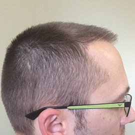 S.H.E. hair implantation method - after direct hair implantation