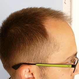 S.H.E. hair implantation method - before hair implantation