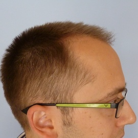 S.H.E. hair implantation method - before hair implantation