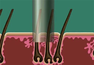 S.H.E hair implantation method