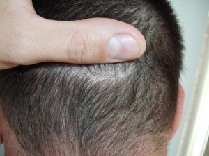 S.H.E. hair implantation method - after hair implantation