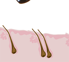 Steps of the S.H.E. hair implantation