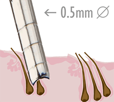 Steps of the S.H.E. hair implantation