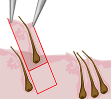 Steps of the S.H.E. hair implantation