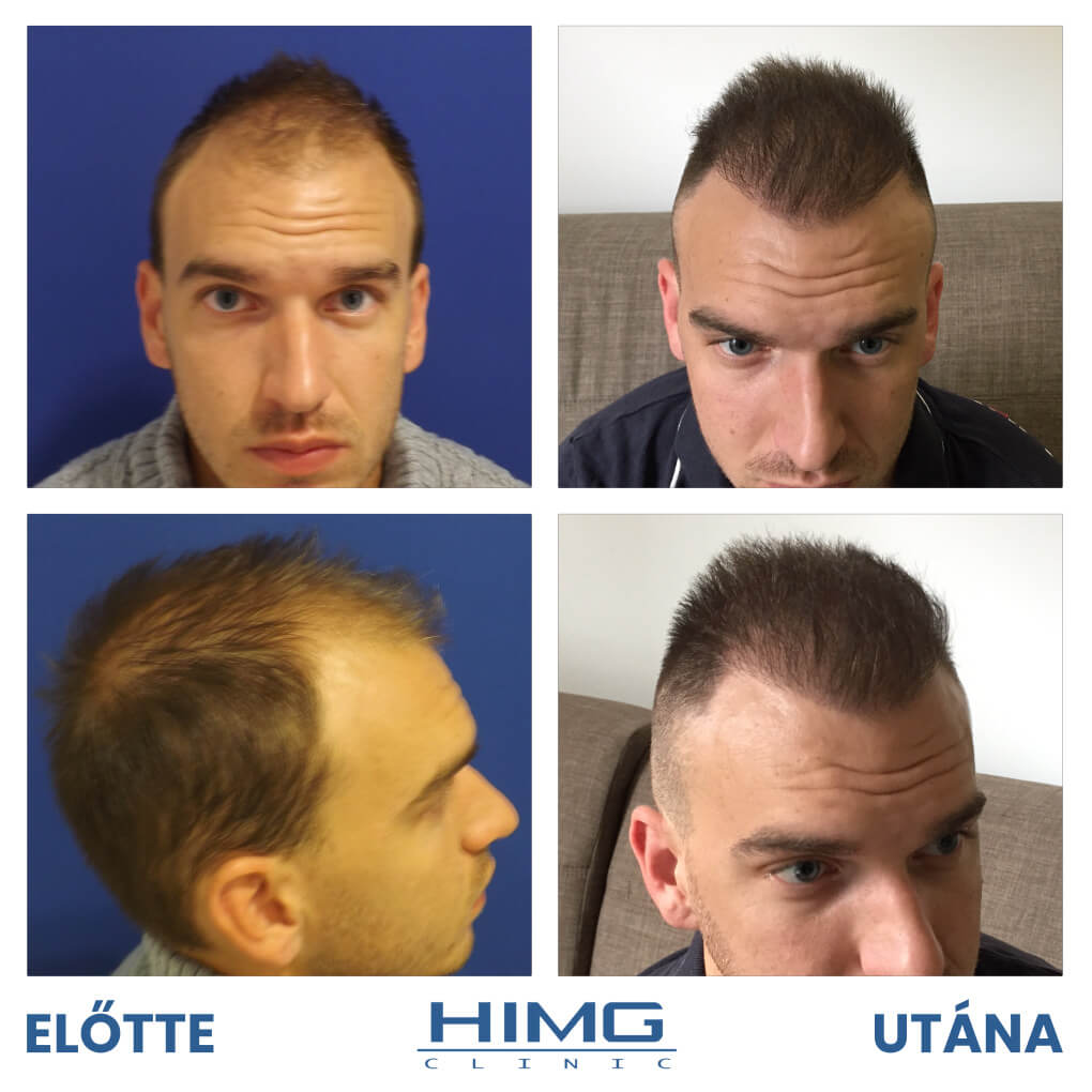 Csetneky Károly hajbeültetés eredménye előtte és utána