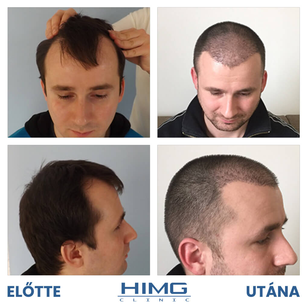 Forgács Attila hajbeültetés eredménye előtte és utána