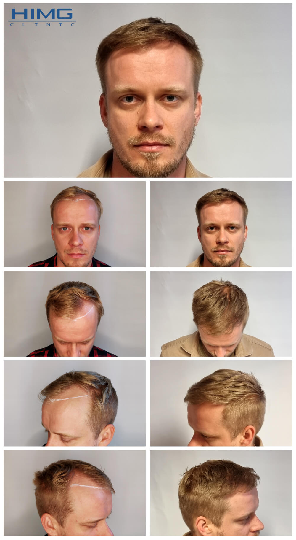 Hair Transplantation Before - After Photos - Results - Peter