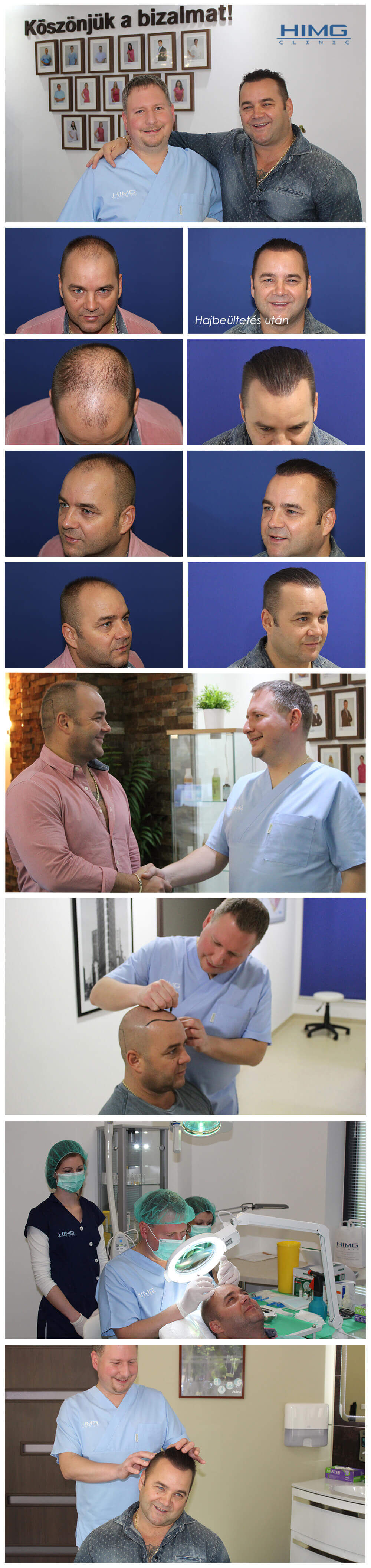 Hair Transplantation Before - After Photos - Results - ÉNB Bécy