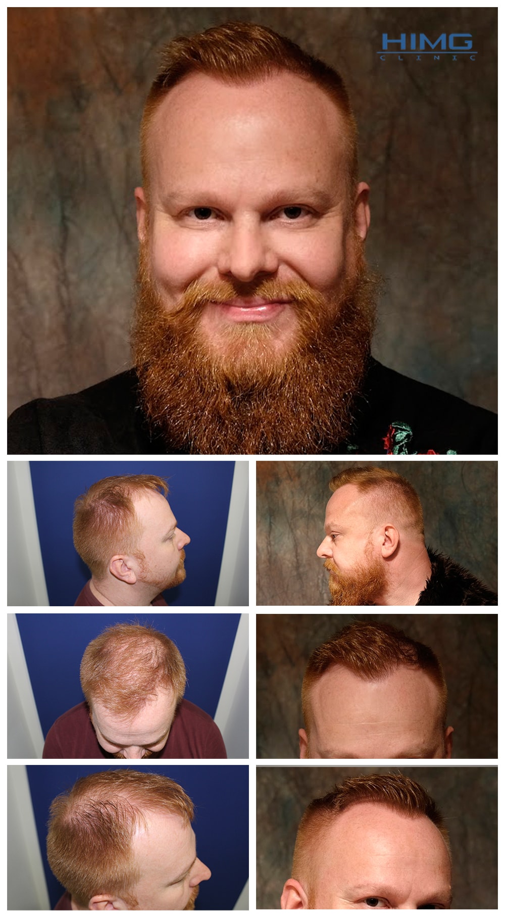 Hair Transplantation Before - After Photos - Results - Rokker Zsoltti