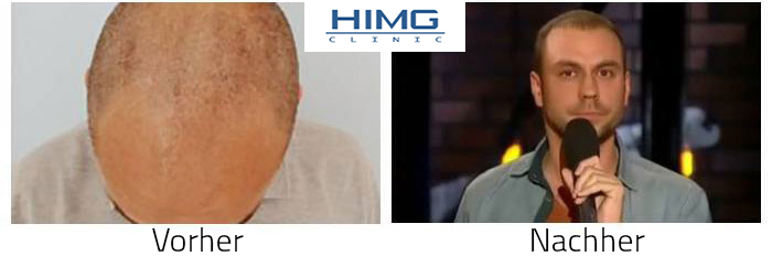 Haartransplantation Ergebnisse - Attila Cs.