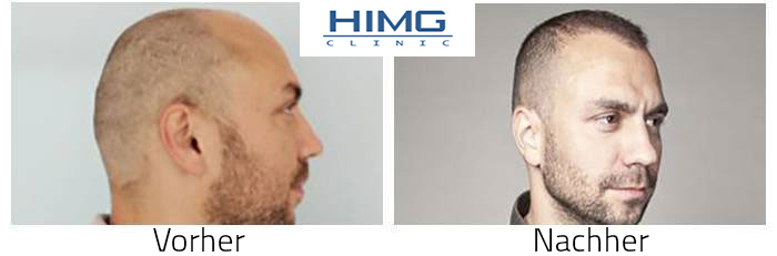 Hajbeültetés előtt után