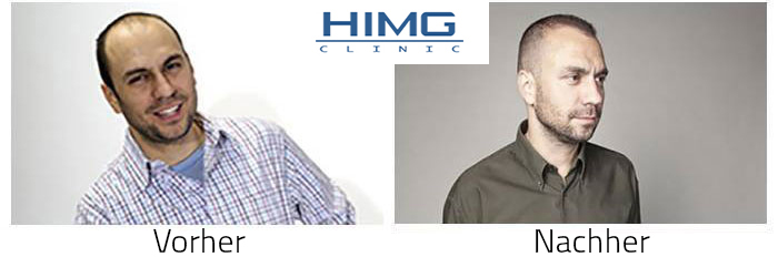 Haarimplantation – Haarimplantation Bilder