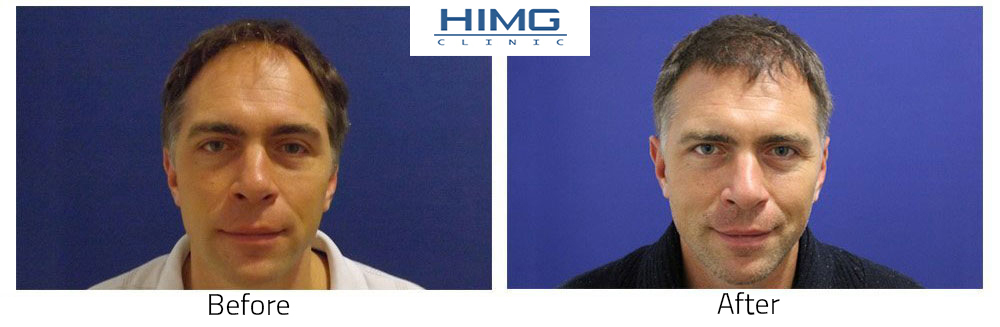 Hair transplant for men Hair implantation for Men