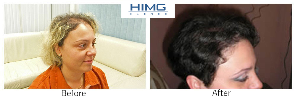Hair Transplantation Before - After Photos - Results Hajbeültetés hajátültetés nőknek