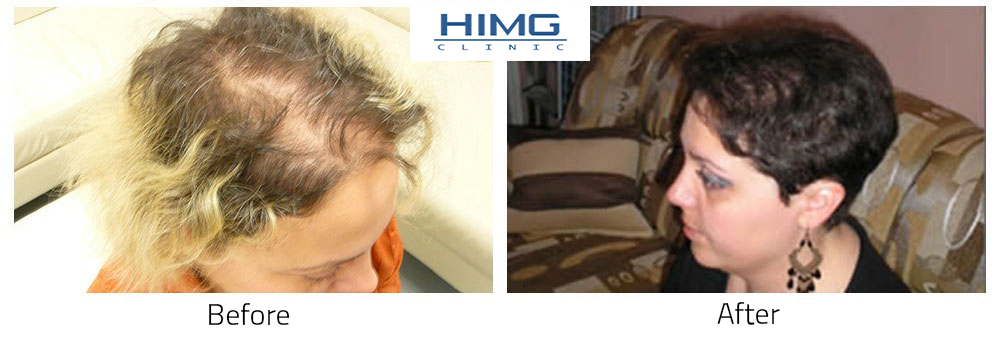 Hair transplantation before after  for women Hair transplantation before after  for women