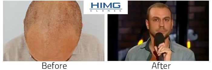 Hair Transplant of Attila Csenki’s hair implantation